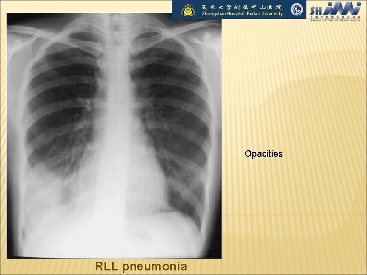 Opacities RLL pneumonia 