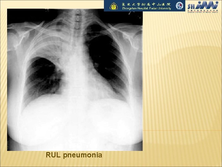 RUL pneumonia 