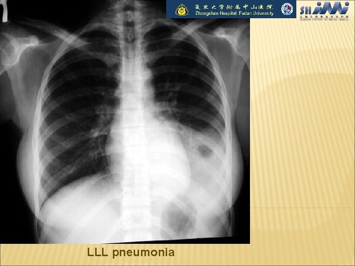 LLL pneumonia 