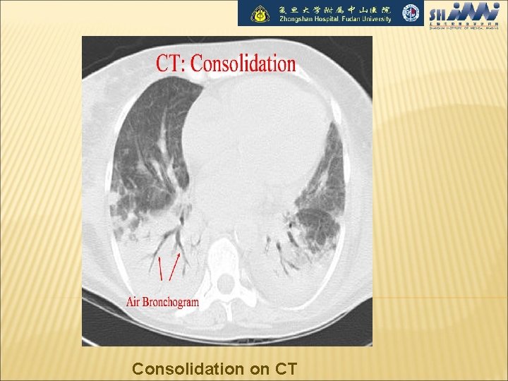 Consolidation on CT 