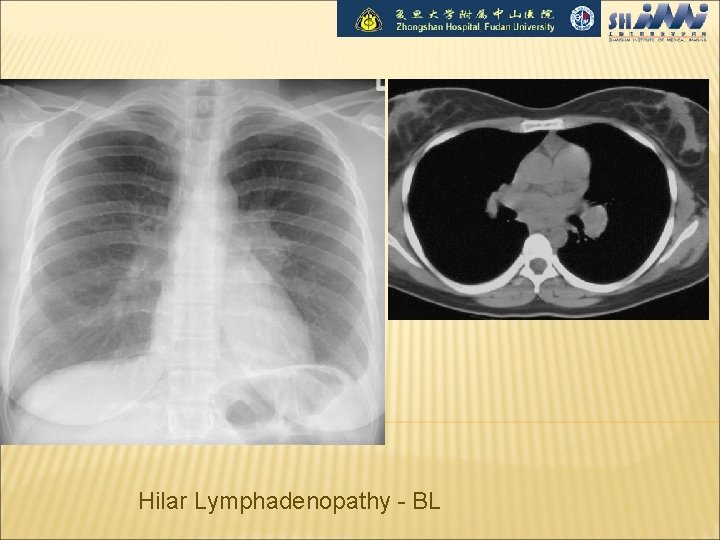 Hilar Lymphadenopathy - BL 