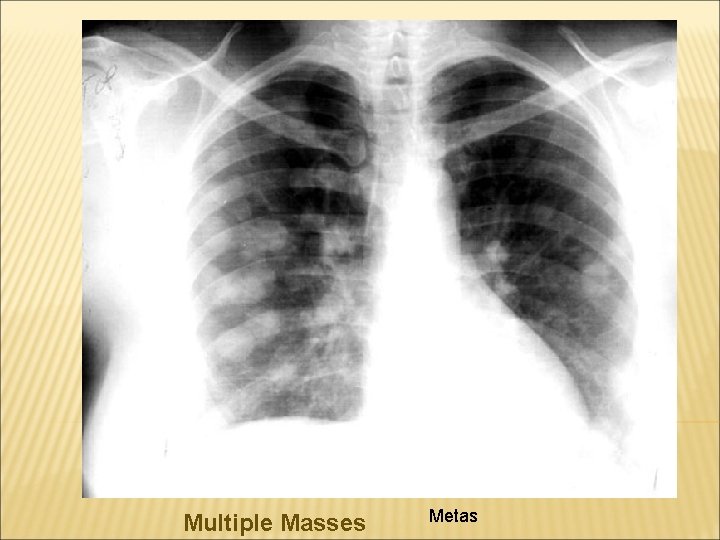 Multiple Masses Metas 