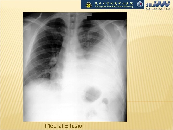 Pleural Effusion 