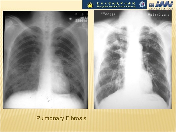 Pulmonary Fibrosis 