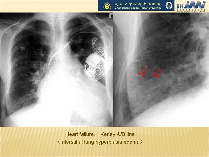 Heart failure， Kerley A/B line （Interstitial lung hyperplasia edema） 