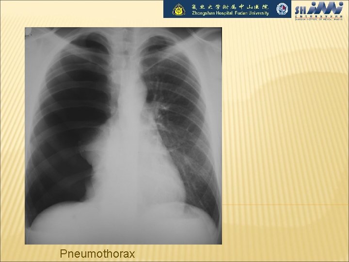Pneumothorax 