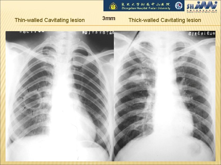 Thin-walled Cavitating lesion 3 mm Thick-walled Cavitating lesion 