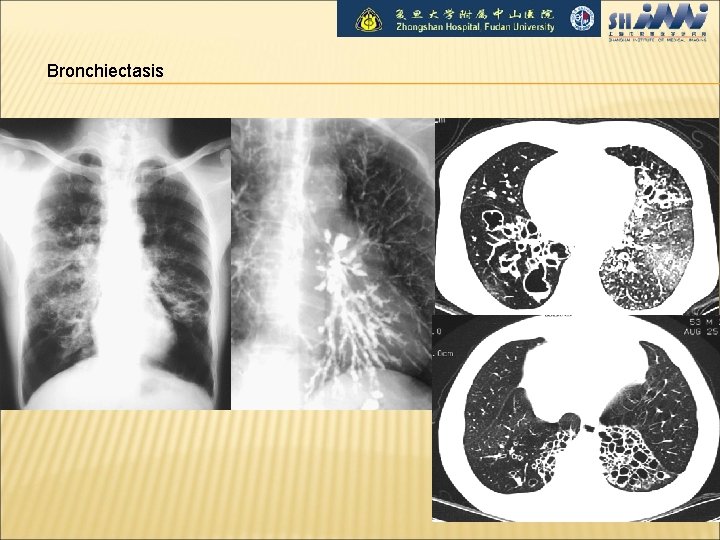 Bronchiectasis 