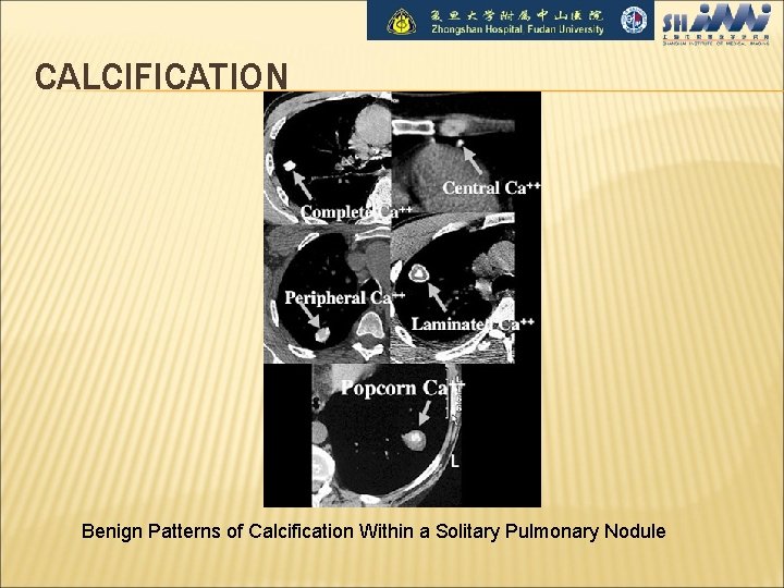 CALCIFICATION Benign Patterns of Calcification Within a Solitary Pulmonary Nodule 