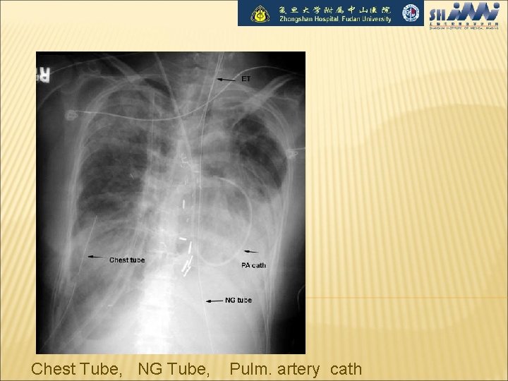 Chest Tube, NG Tube, Pulm. artery cath 
