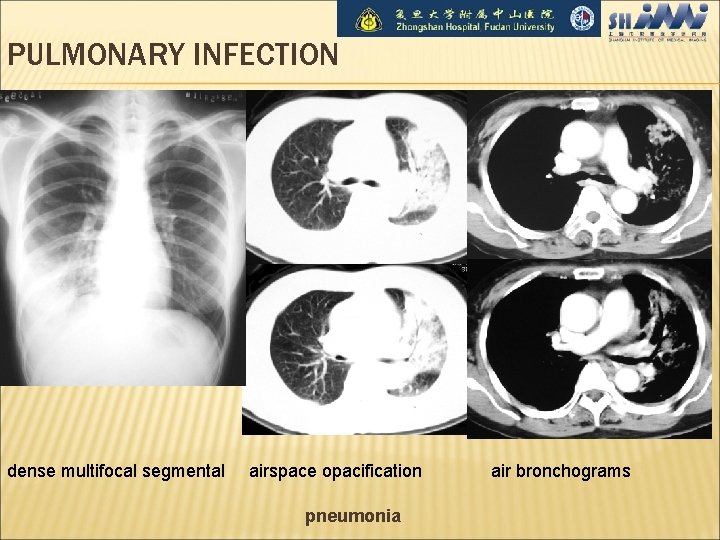 PULMONARY INFECTION dense multifocal segmental airspace opacification pneumonia air bronchograms 