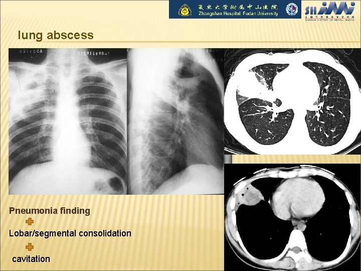 lung abscess Pneumonia finding Lobar/segmental consolidation cavitation 