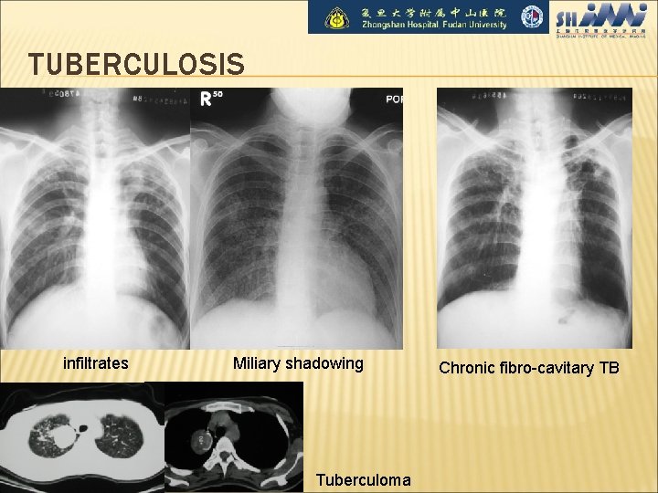 TUBERCULOSIS infiltrates Miliary shadowing Tuberculoma Chronic fibro-cavitary TB 