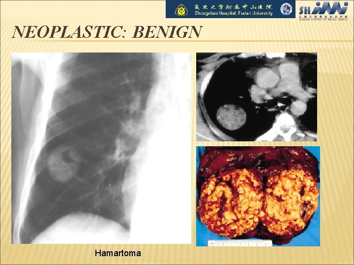 NEOPLASTIC: BENIGN Hamartoma 