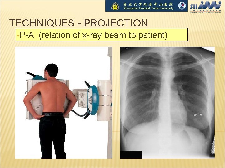 TECHNIQUES - PROJECTION • P-A (relation of x-ray beam to patient) 