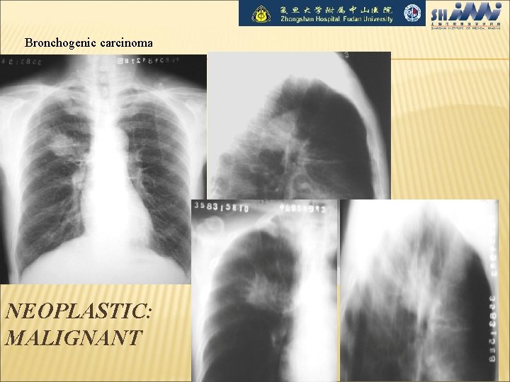 Bronchogenic carcinoma NEOPLASTIC: MALIGNANT 