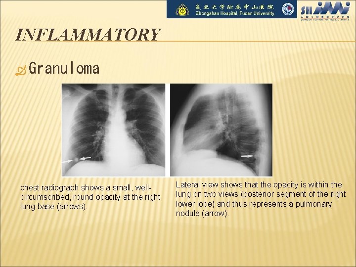 INFLAMMATORY Granuloma chest radiograph shows a small, wellcircumscribed, round opacity at the right lung