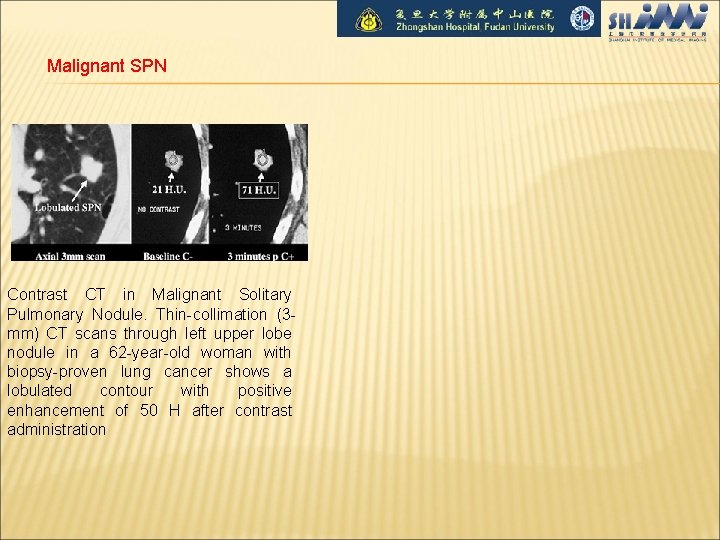 Malignant SPN Contrast CT in Malignant Solitary Pulmonary Nodule. Thin-collimation (3 mm) CT scans