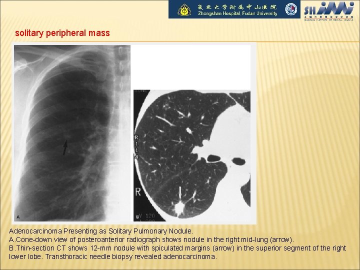 solitary peripheral mass Adenocarcinoma Presenting as Solitary Pulmonary Nodule. A. Cone-down view of posteroanterior