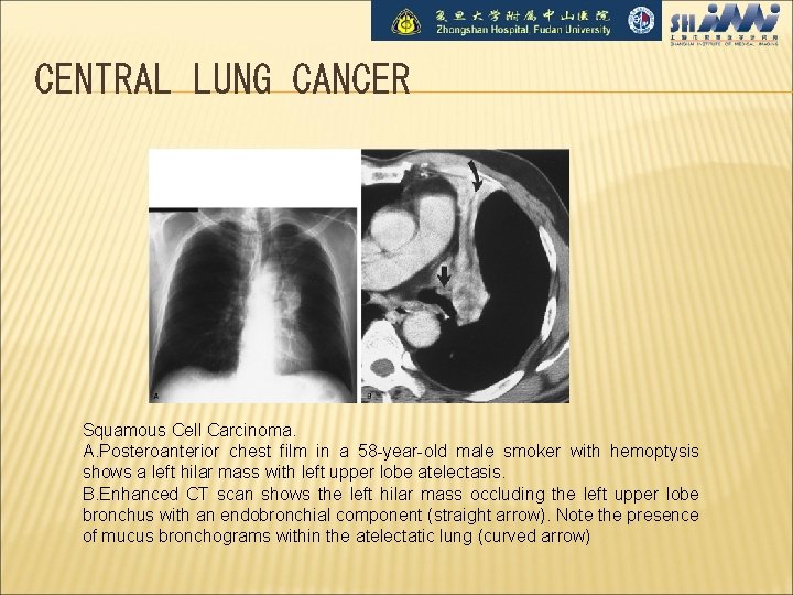 CENTRAL LUNG CANCER Squamous Cell Carcinoma. A. Posteroanterior chest film in a 58 -year-old