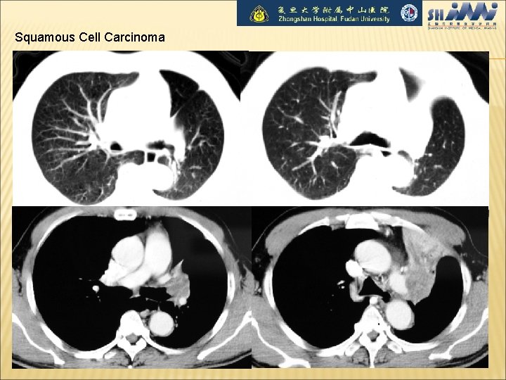 Squamous Cell Carcinoma 