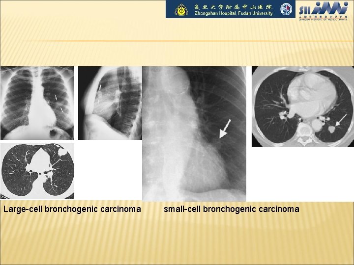 Large-cell bronchogenic carcinoma small-cell bronchogenic carcinoma 