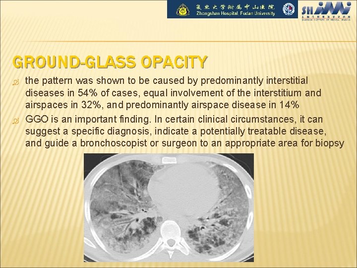 GROUND-GLASS OPACITY the pattern was shown to be caused by predominantly interstitial diseases in