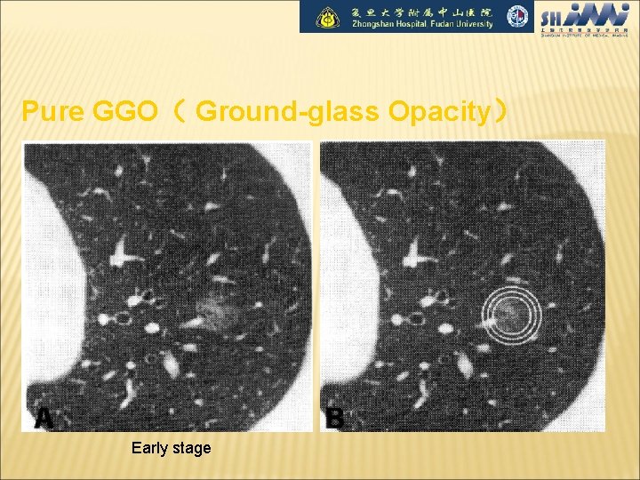 Pure GGO（ Ground-glass Opacity） Early stage 
