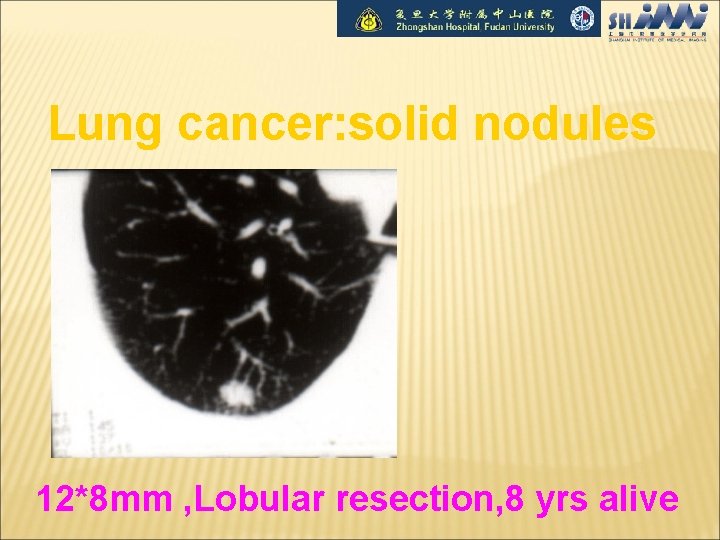 Lung cancer: solid nodules 12*8 mm , Lobular resection, 8 yrs alive 