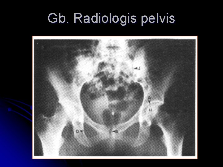 Gb. Radiologis pelvis 