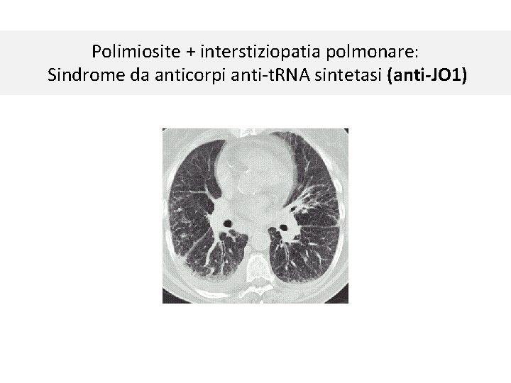 Polimiosite + interstiziopatia polmonare: Sindrome da anticorpi anti-t. RNA sintetasi (anti-JO 1) 