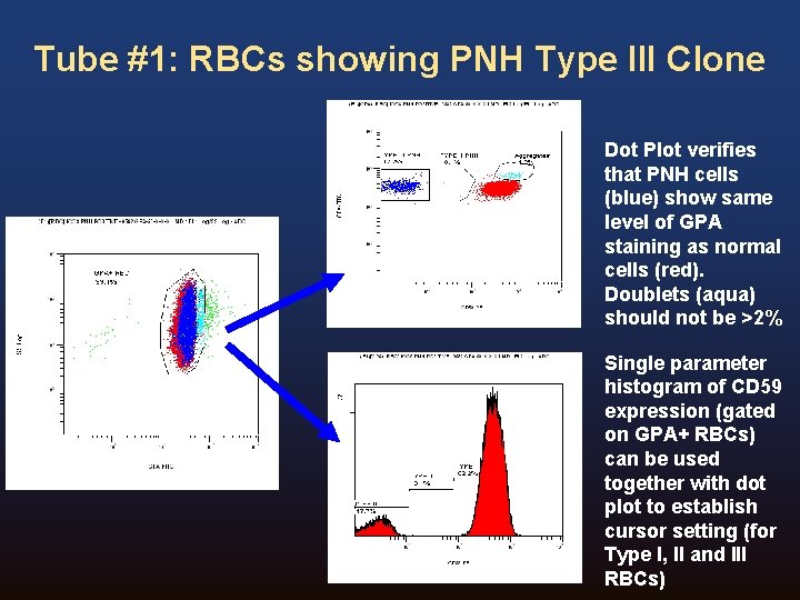 Tube #1: RBCs showing PNH Type III Clone Dot Plot verifies that PNH cells Tube #1: RBCs showing PNH Type III Clone Dot Plot verifies that PNH cells