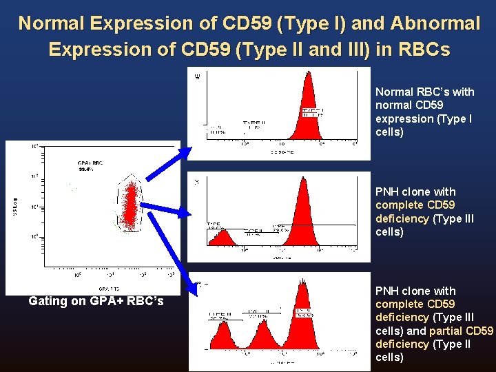 Normal Expression of CD 59 (Type I) and Abnormal Expression of CD 59 (Type Normal Expression of CD 59 (Type I) and Abnormal Expression of CD 59 (Type