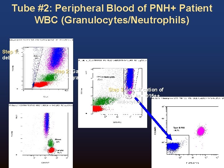 Tube #2: Peripheral Blood of PNH+ Patient WBC (Granulocytes/Neutrophils) Step 1: Gating out debris Tube #2: Peripheral Blood of PNH+ Patient WBC (Granulocytes/Neutrophils) Step 1: Gating out debris