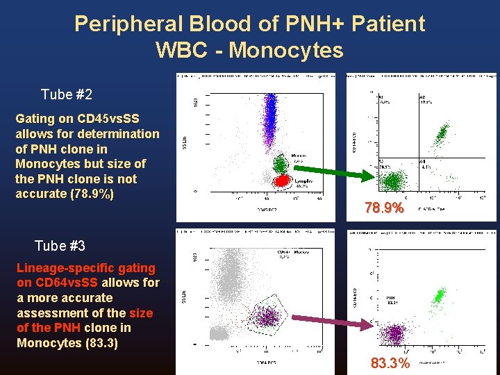 Peripheral Blood of PNH+ Patient WBC - Monocytes Tube #2 Gating on CD 45 Peripheral Blood of PNH+ Patient WBC - Monocytes Tube #2 Gating on CD 45