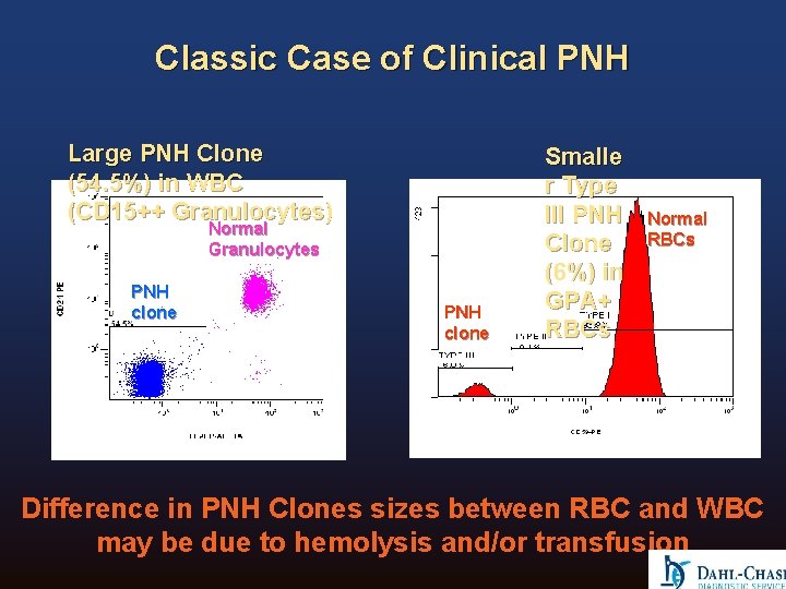 Classic Case of Clinical PNH Large PNH Clone (54. 5%) in WBC (CD 15++ Classic Case of Clinical PNH Large PNH Clone (54. 5%) in WBC (CD 15++