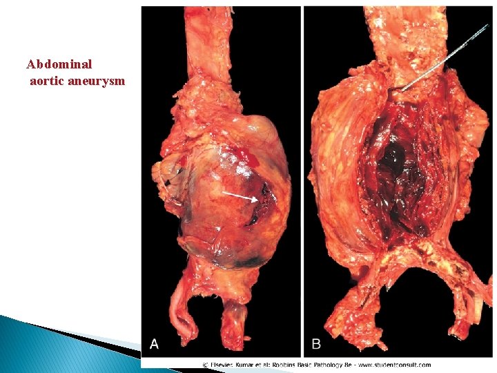 Abdominal aortic aneurysm 