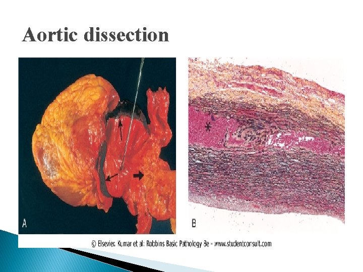 Aortic dissection 