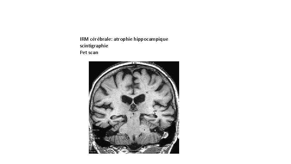 IRM cérébrale: atrophie hippocampique scintigraphie Pet scan 