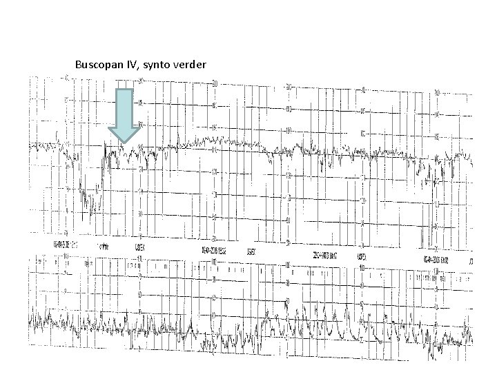 Buscopan IV, synto verder 