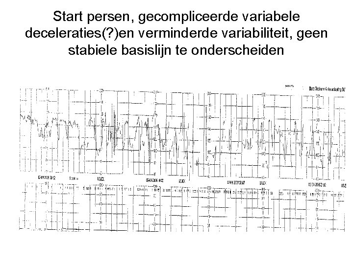 Start persen, gecompliceerde variabele deceleraties(? )en verminderde variabiliteit, geen stabiele basislijn te onderscheiden 