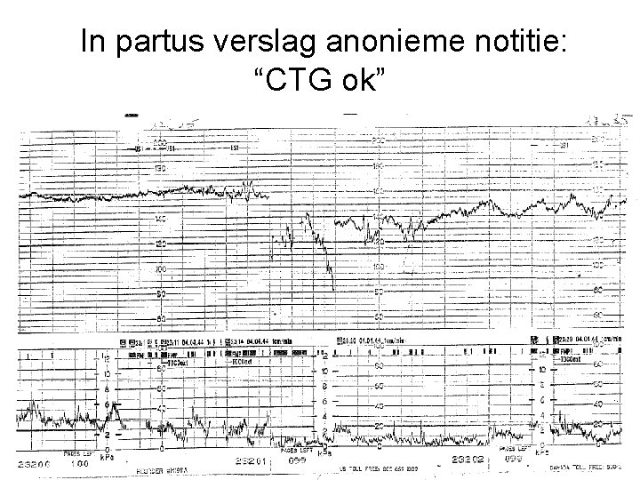 In partus verslag anonieme notitie: “CTG ok” 