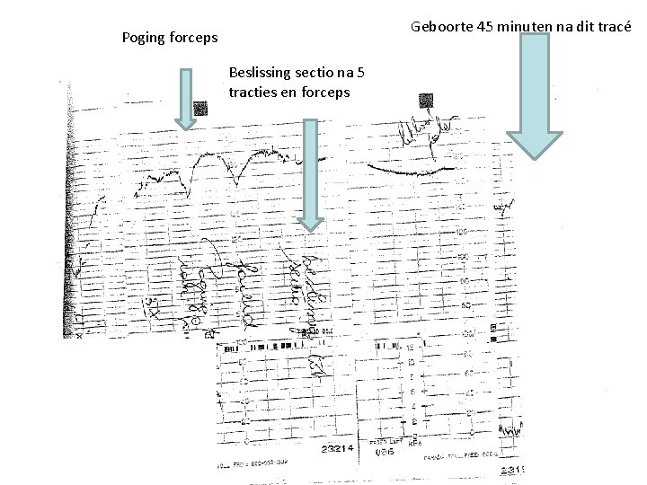 Geboorte 45 minuten na dit tracé Poging forceps Beslissing sectio na 5 tracties en