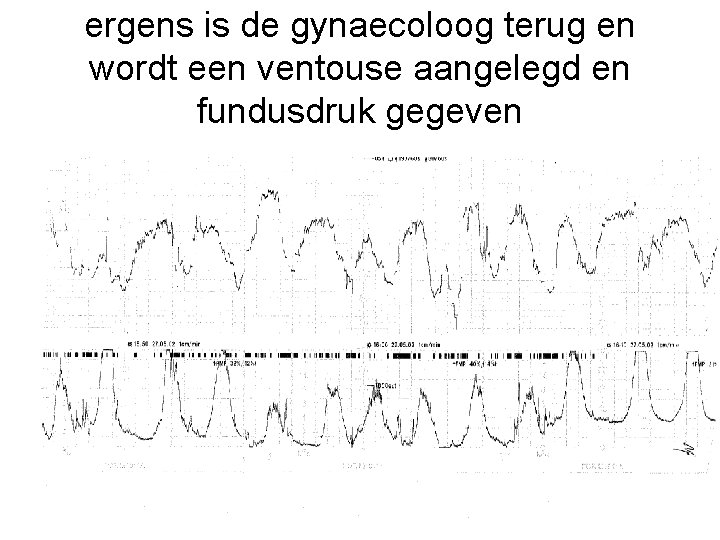 ergens is de gynaecoloog terug en wordt een ventouse aangelegd en fundusdruk gegeven 