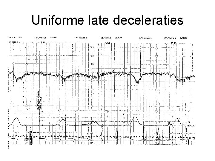 Uniforme late deceleraties 