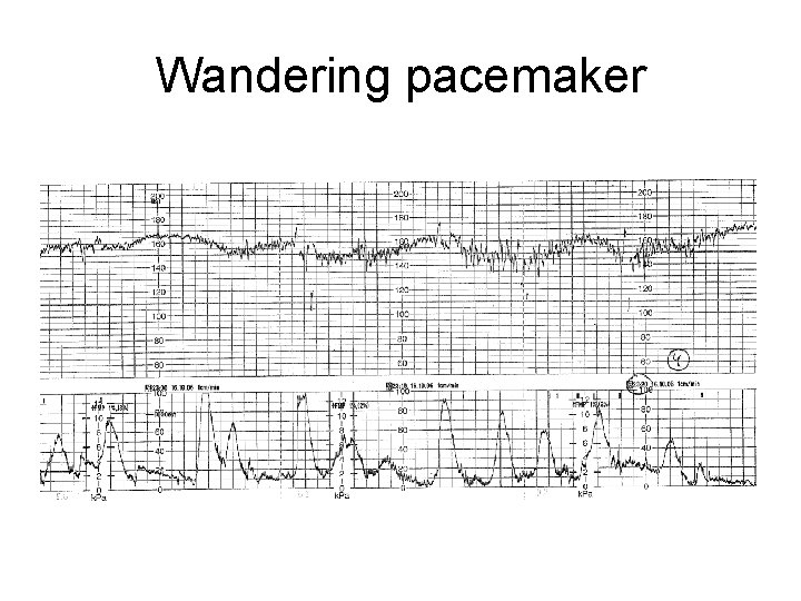 Wandering pacemaker 