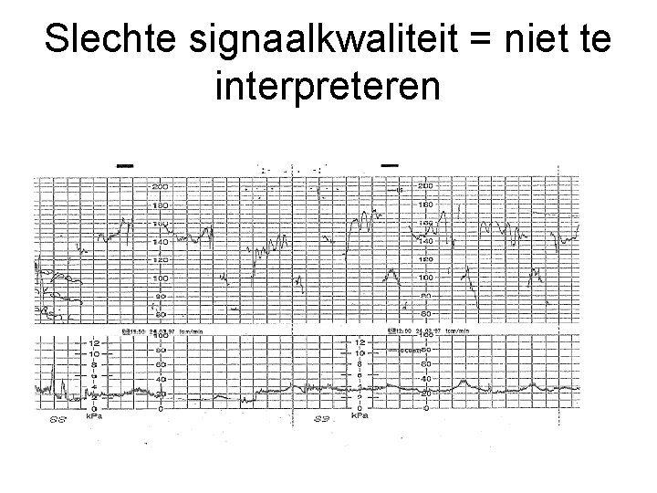 Slechte signaalkwaliteit = niet te interpreteren Slechte signaalkwaliteit = niet te interpreteren