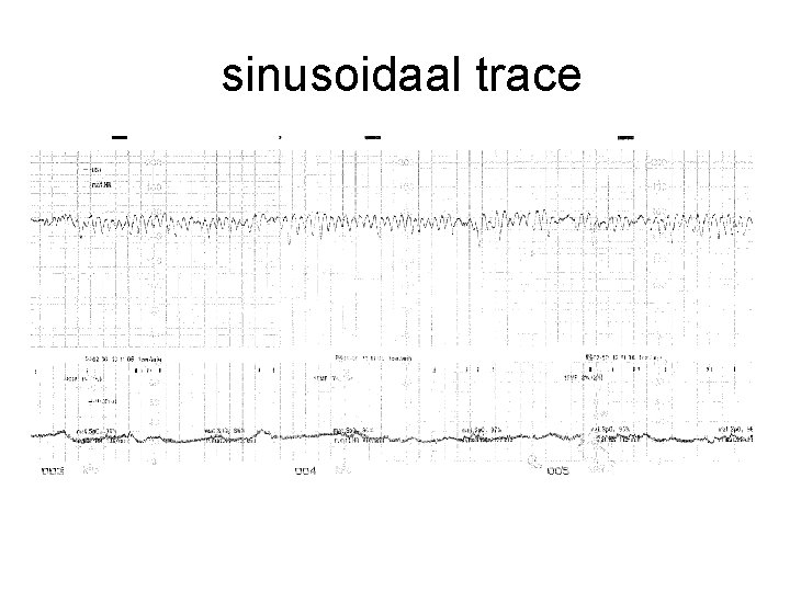 sinusoidaal trace 