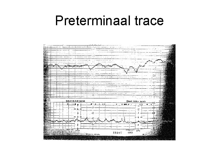 Preterminaal trace 