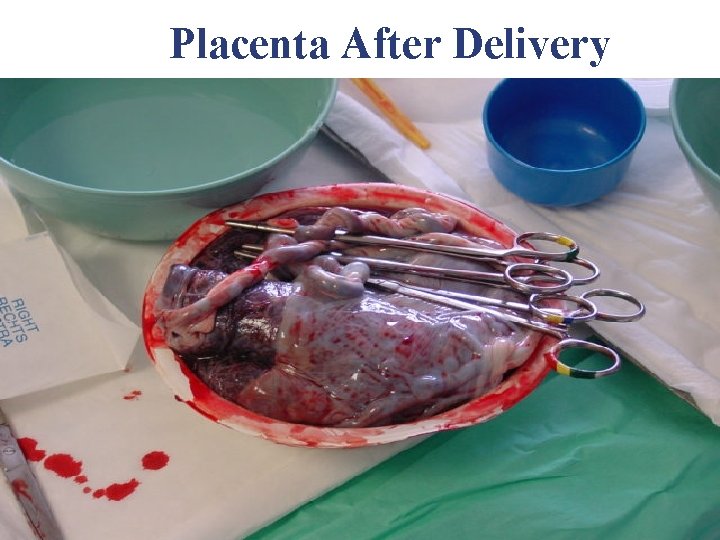Placenta After Delivery Placenta After Delivery